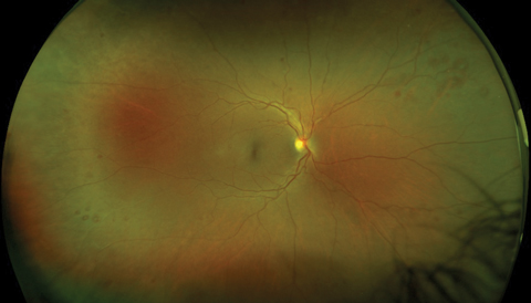 Our patient’s right fundus demonstrates scattered midperipheral, white-centered retinal hemorrhages. Similar findings also appeared in the left fundus.