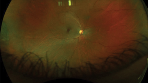 Fig. 1. The patient presented with 20/50 vision but no complaints. Fundus exam was suspicious for macular hole.
