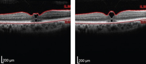 Fig. 2. Upon referral, the initial OCT scan (left) showed VMT and early macular hole formation, but vision was stable. Follow-up one month later (right) showed slight worsening. Patient was educated of recommendation for vitrectomy if FTMH develops.