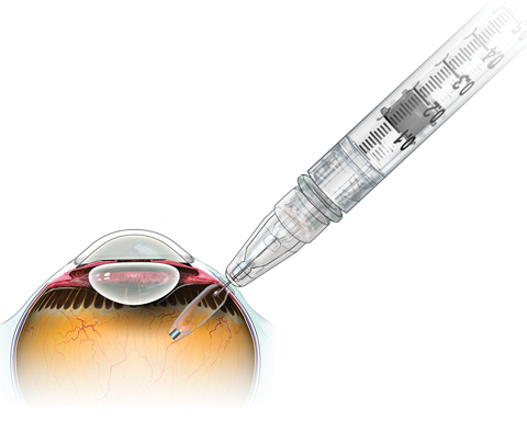 After the device  releases all of its initial supply in the reservoir, retina specialists can reload it in the office with a custom needle that is part of the system. This approach is expected to cut the number of injections down from current levels.