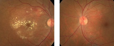 Figs. 1 & 2. Note the obvious finding in the right eye (at left) of our patient, but don’t overlook the finding in the left eye. 