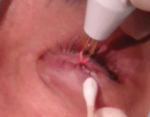 Lid margin papilloma excision, Papilloma in eyelid
