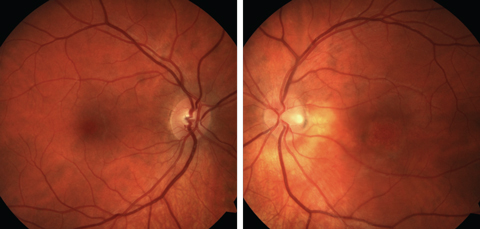 Fig. 6. Fundus photographs of the right and left eyes.