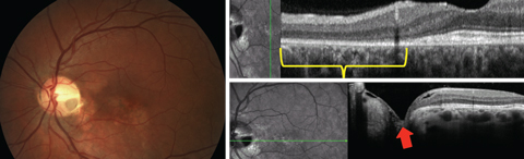 Fig. 8. This patient has an optic disc pit without intraretinal or subretinal fluid. Outer retinal disruption (section in yellow brackets) exists indicative of possible serous detachment in the past. Cavitation in the area of the pit is shown with the red arrow.