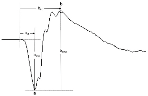 Fig. 1. This normal ffERG dark-adapted 3.0 response shows the a-wave and b-wave components and the measurement of their response amplitudes (aamp and bamp) and implicit times (ai.t. and bi.t.).