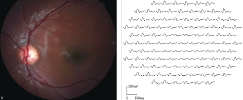 Fig. 6. Marked diffuse mfERG response attenuation was detected in both eyes of a 13-year-old Stargardt disease patient. This fundus image and corresponding mfERG show the results from the left eye.
