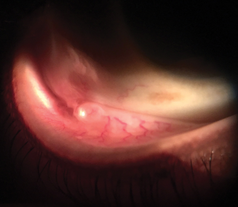 A 55-year-old patient presented urgently with a foreign body sensation in his right eye. Can this image help explain his issue? 
