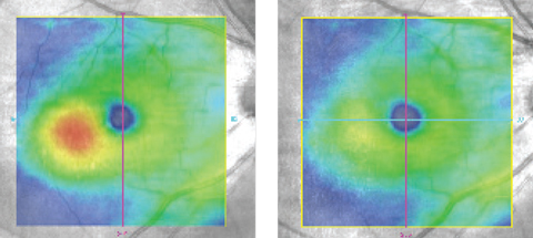 Figs. 4 and 5. The macular edema (left) resolved without therapy at three months (right).