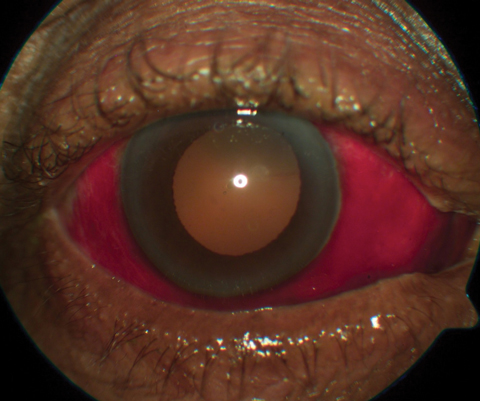 This patient being anti-coagulated with warfarin presented with subconjunctival hemorrhage.