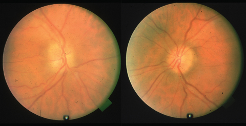This patient’s toxic optic neuropathy is due to amiodarone use.
