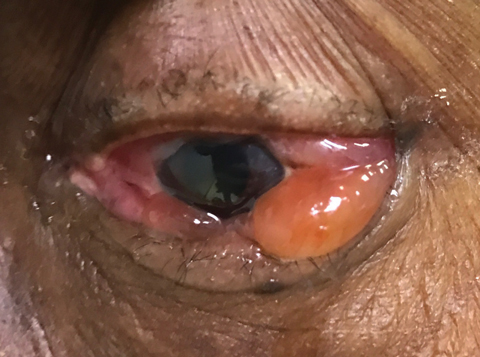 This patient presented two days after bisphosphonate infusion with severe ocular inflammation.