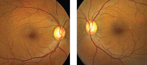 Fig. 1. These fundus photographs show our 53-year-old Hispanic patient. Although her initial complaint was a red eye, can you identify any other pathology here?