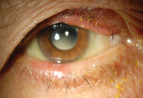 This patient’s swollen eyelid conceals a hordeolum, a common condition caused by a bacterial infection of the sebaceous glands.