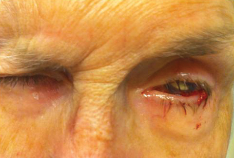 An 81-year-old with a history of herpes simplex keratopathy presented with a bleeding, painful left eye. What can this image and her history tell you about her likely diagnosis?