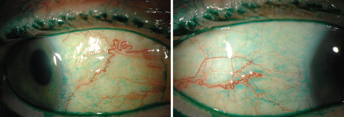 Fig. 4. Osmolarity is a helpful tool to use in addition to other dry eye diagnostics, such as lissamine green staining on the conjunctiva, seen here. 