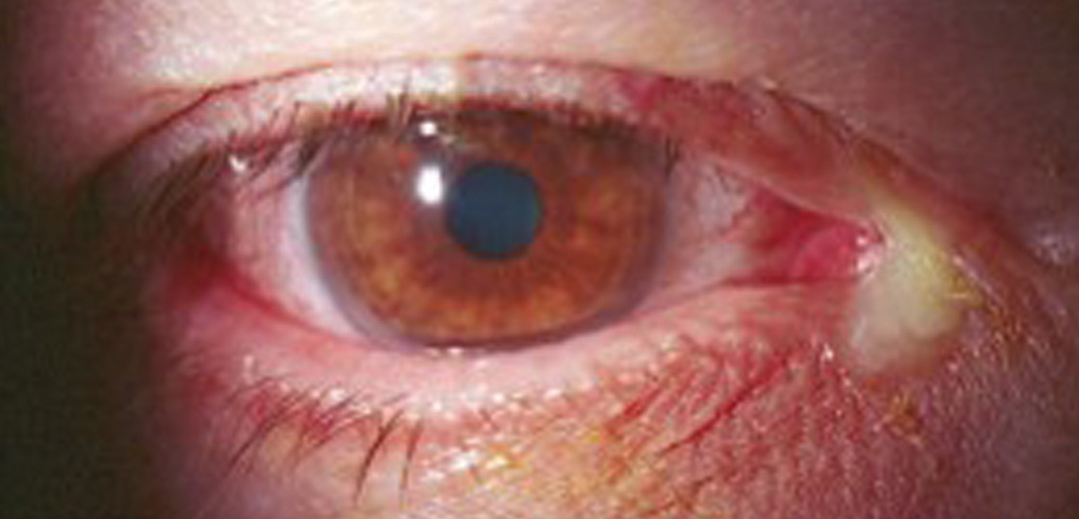 Using 1.0% or 0.25% povidone-iodine can be effective against cases of bacterial conjunctivitis, shown here.