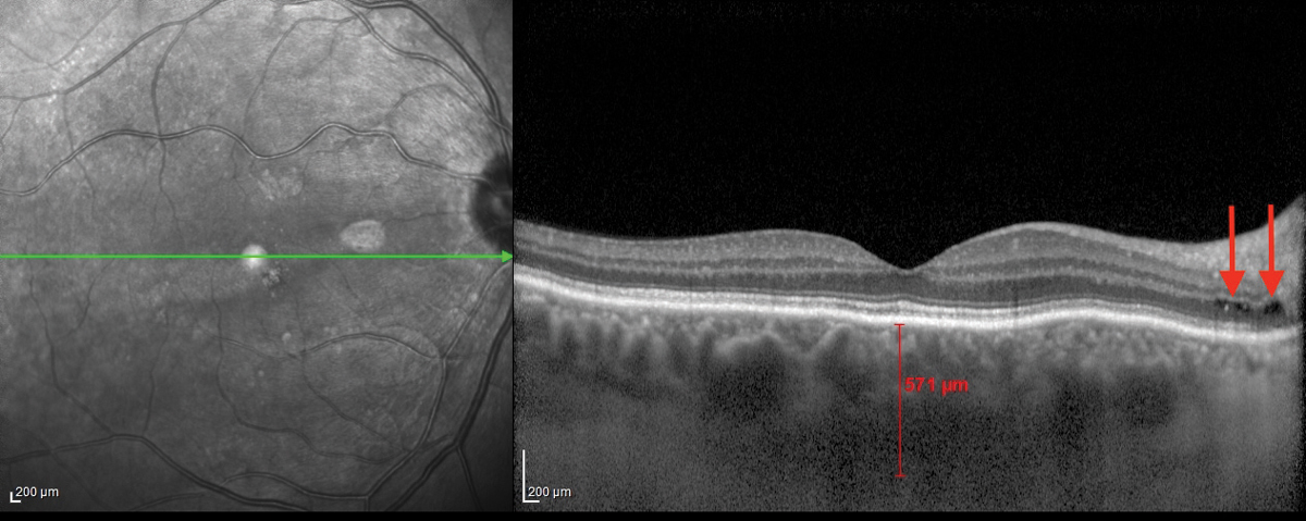 Fig. 1. This OCT B-scan shows the patient’s right eye. 