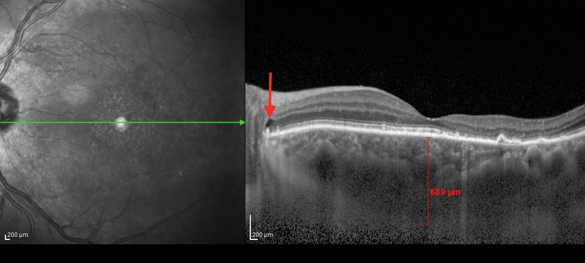 Fig. 2. This OCT B-scan shows the patient’s left eye. The posterior subretinal fluid that may have extended from the cystic spaces is noted with red arrows at the optic disc margin.