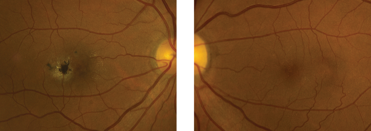 Figs. 1 and 2. This is the right and left eye of our patient. Note the pigment changes seen in the right eye. But don’t ignore the left eye—what do you see? 
