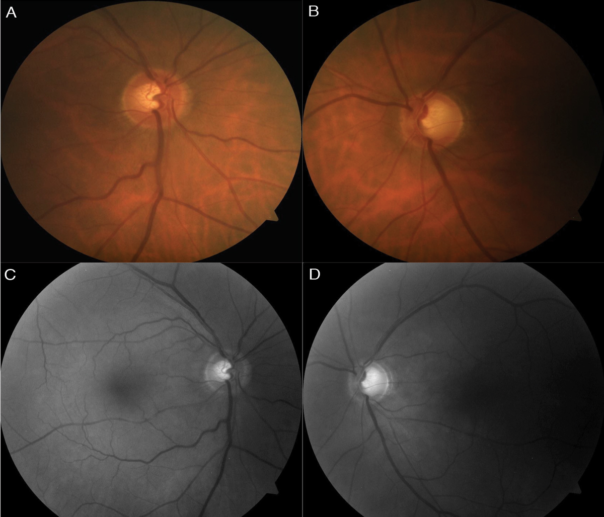 Fig. 1. Color fundus photo (A) of the right optic nerve shows mild superior thinning, while the left (B) shows noticeable superior, temporal and inferior thinning. Red-free photos show loss of the bright RNFL pattern superiorly in the right (C) and both superiorly and inferiorly, extending temporal, in the left (D). 