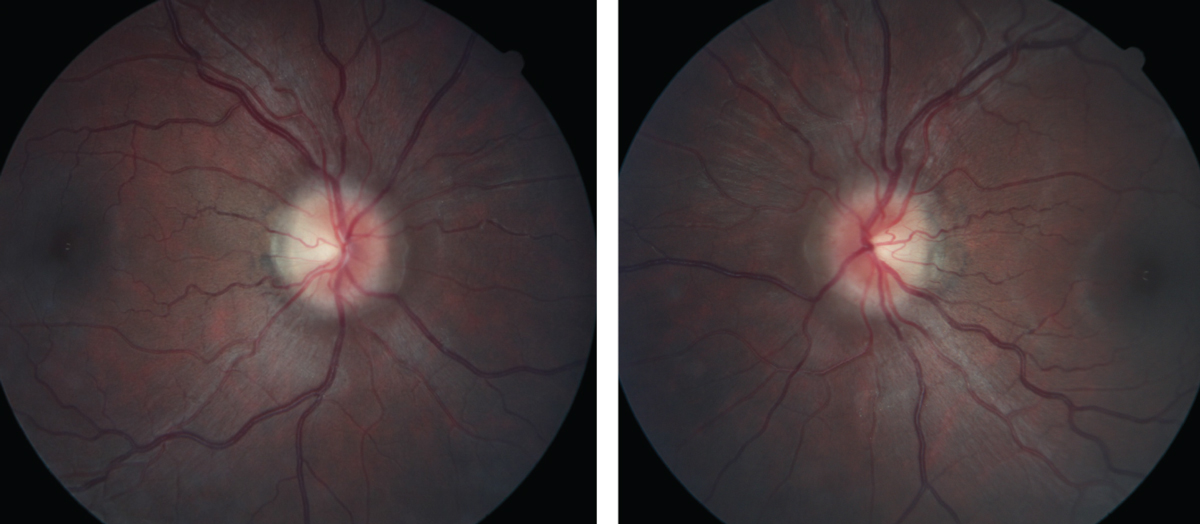 Figs. 1 and 2. At left, the patient’s right fundus as it appeared on her initial, urgent presentation. At right, her left eye, also at initial presentation. Note the “C” shaped halo shadowing in both the right and left eyes, with the temporal neuroretinal rim essentially intact.