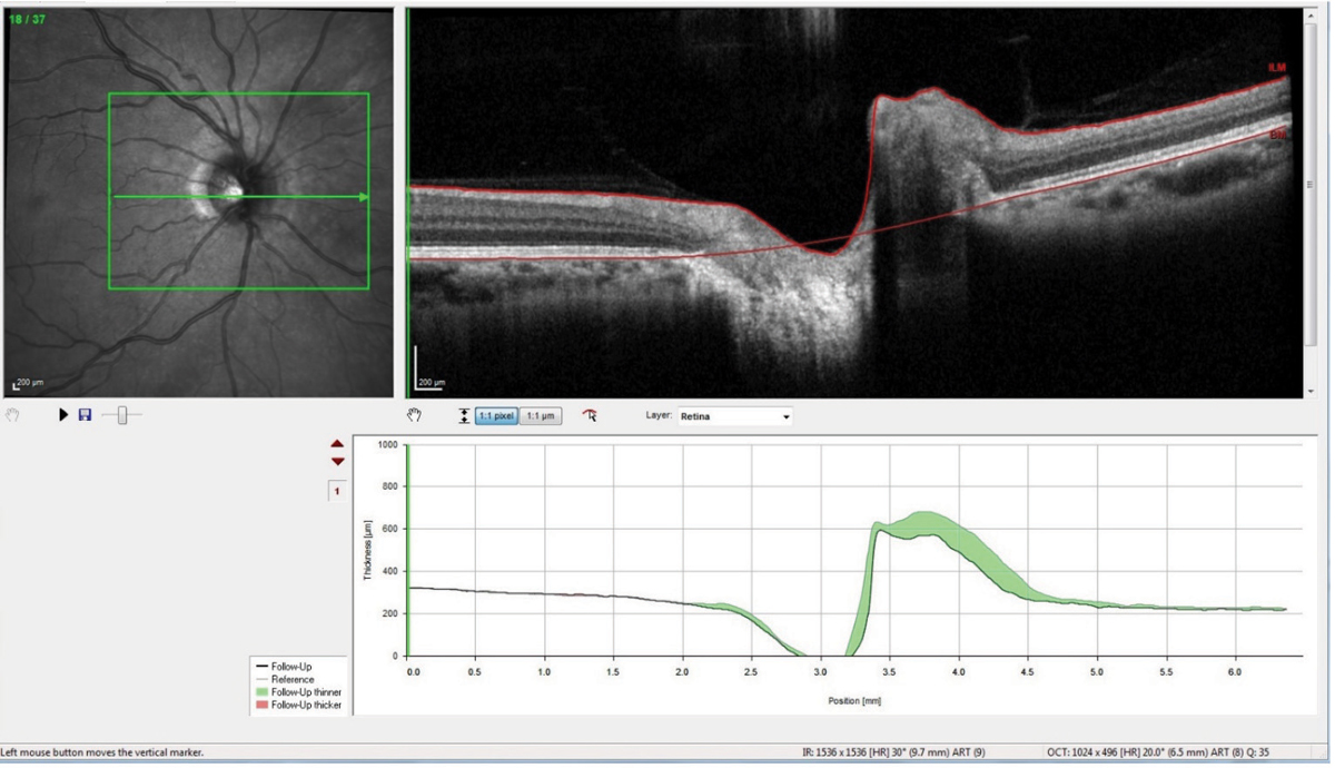 Fig. 4. This optic nerve raster OCT scan is a follow-up showing significant reduction in the nasal neuroretinal rim swelling, as evidenced by the green areas in the change analysis.