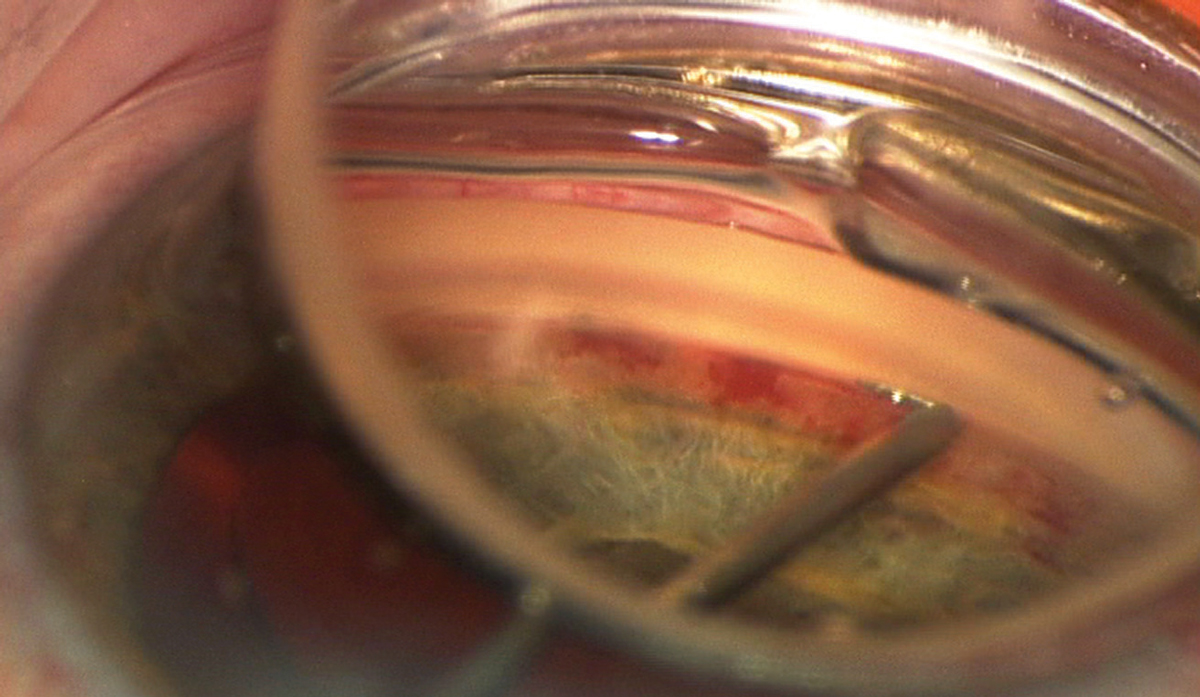 Under magnification you can see an iStent being inserted through the trabecular meshwork during cataract surgery.