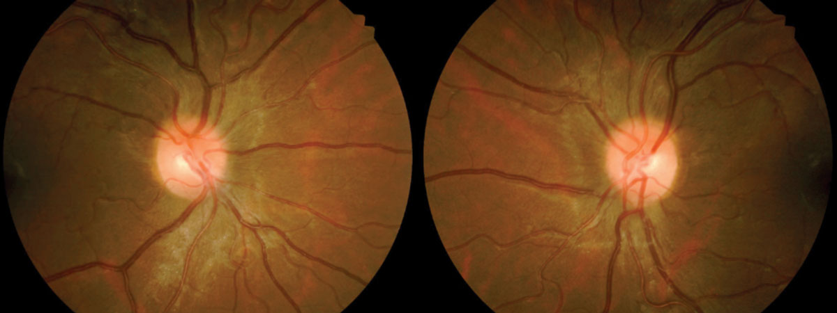 Fig. 2. Fundus images from February 2018. Note disc edema resolution.