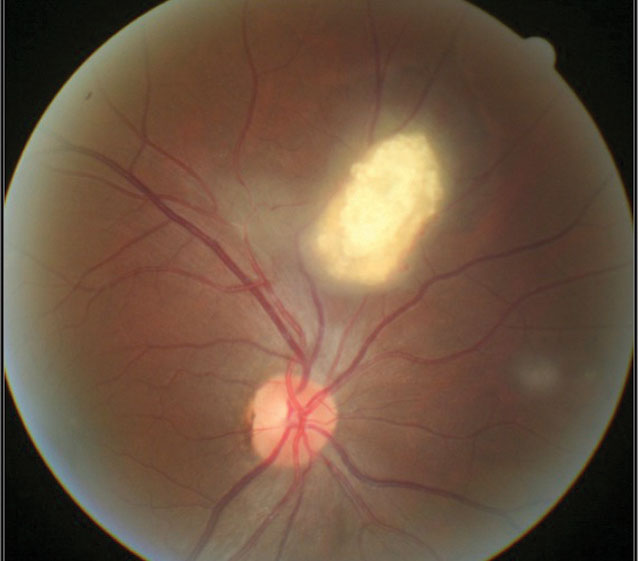 Fig. 1. A mulberry-like lesion consistent with retinal astrocytic hamartoma.