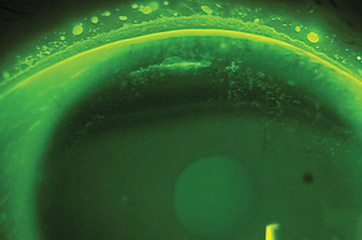 Superior epithelial arcuate lesions, as seen here, can result from mechanical friction of a contact lens on the cornea and are mostly seen in those who wear high-modulus SiHy contact lenses.