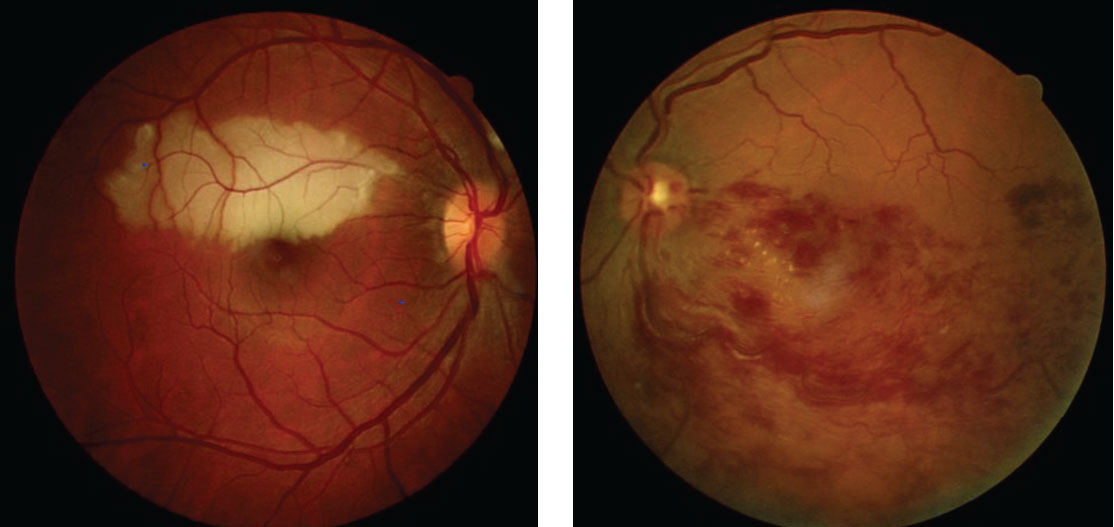 These eyes display branch retinal artery occlusion. Tobacco use in particular can contribute to problems in the eye’s vasculature system. 