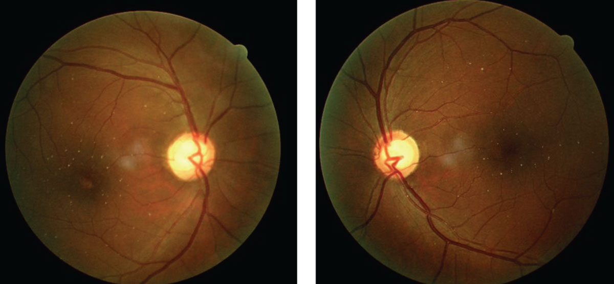 Talc retinopathy, as shown in these fundus images, is associated with heroin use.