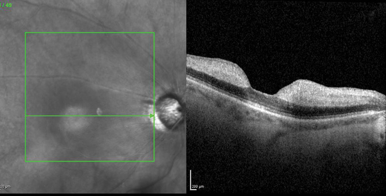 Fig. 1. OCT is an invaluable diagnostic tool to assess possible retinal thickening, as seen here in another acute CRAO patient.