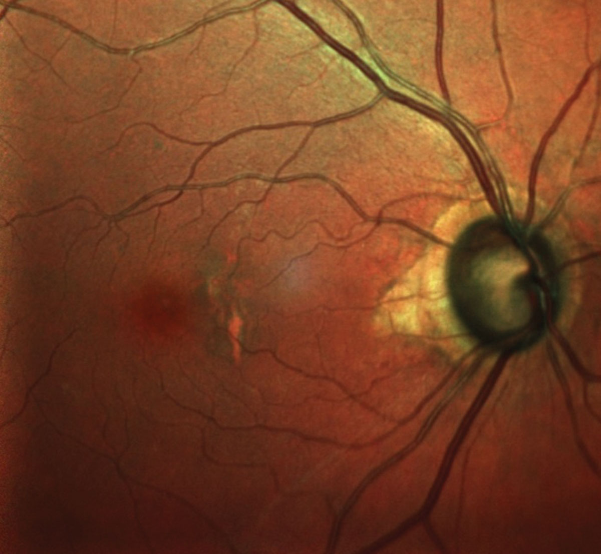 The patient’s right eye, shows advanced glaucomatous damage and macular changes consistent with her age.