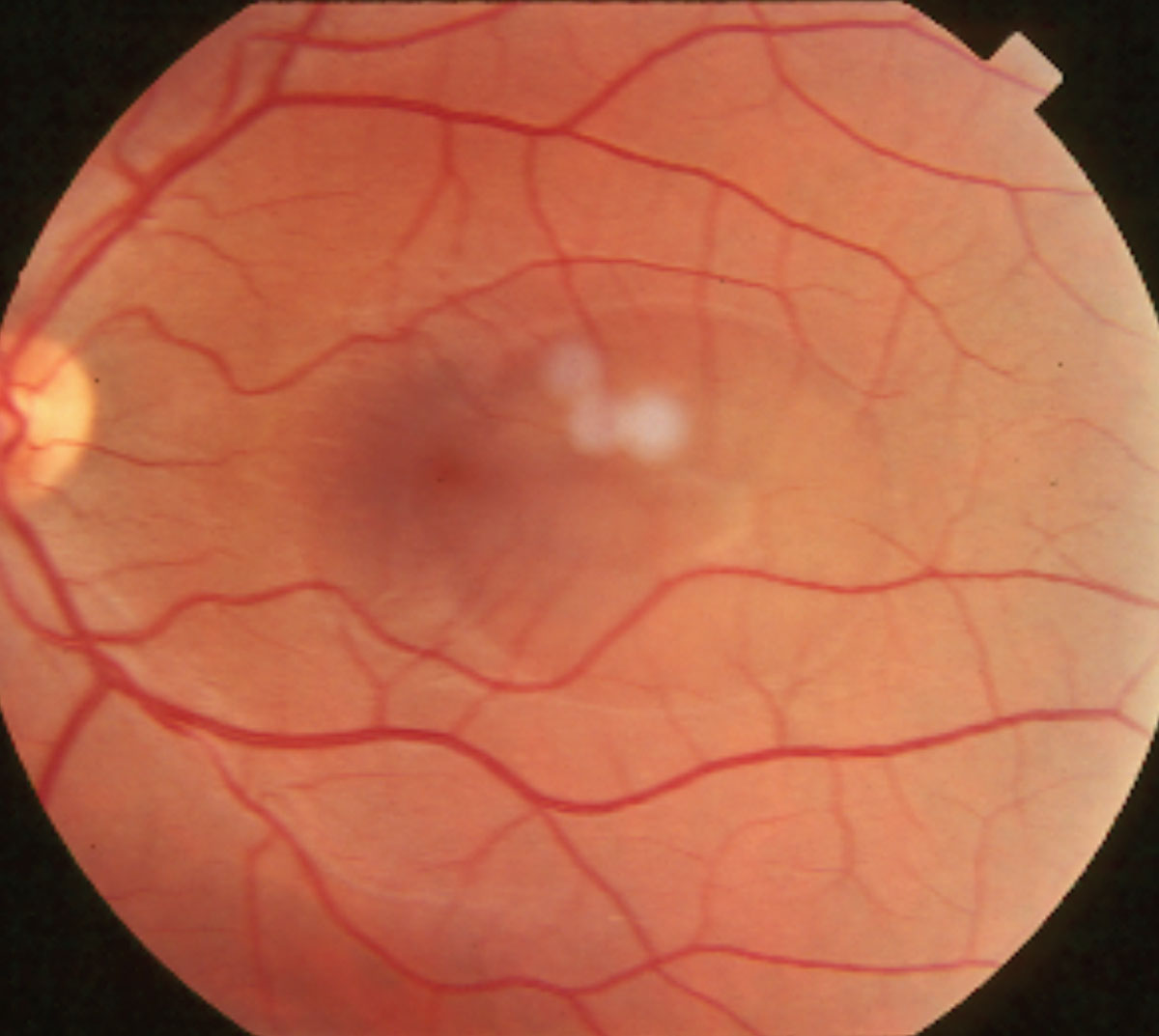 This patient’s fundus photo shows a large paracentral central serous chorioretinopathy. This pathology can cause sudden-onset blurred vision and decreased color perception in addition to other complaints.
