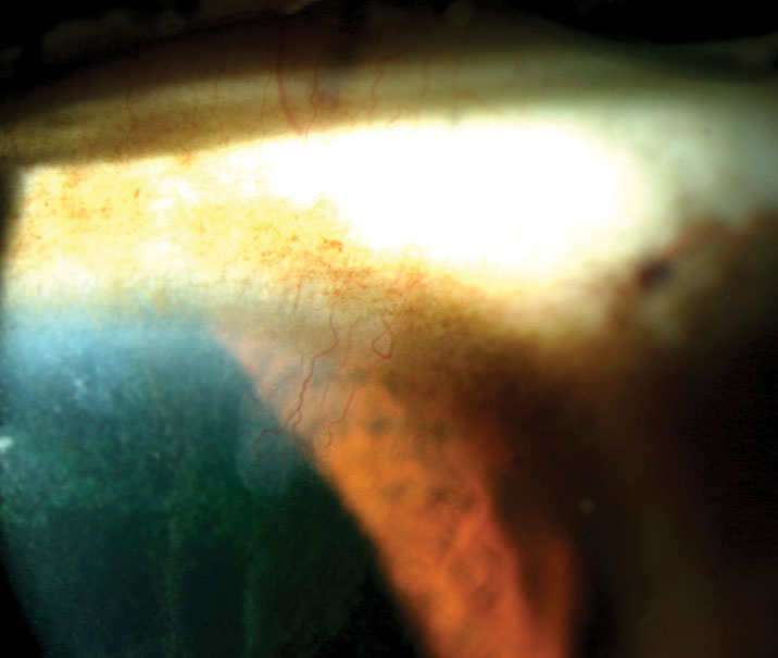 Fig. 5. Note the classic “icicle” staining pattern extending toward the pupil in this patient with limbal stem cell deficiency.