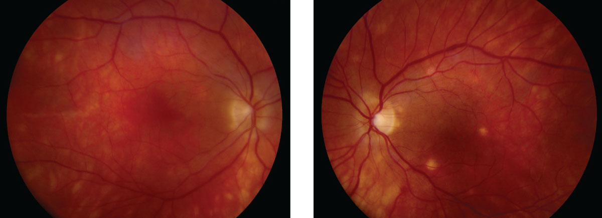 Fig. 1. These fundus shots show noticeable changes to the patient’s retina.