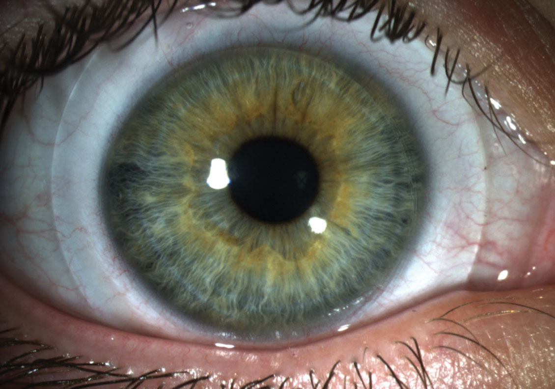 Fig. 5. Scleral lens showing optimal landing onto the bulbar conjunctiva while vaulting over the corneal surface.