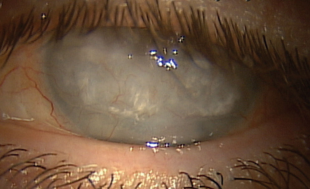 Fig. 7. This patient who experienced a central retinal artery occlusion later developed band keratopathy and corneal scarring.