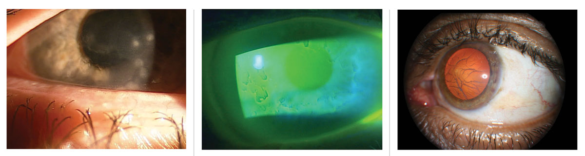Figs. 3-5. Preventing corneal scarring is key when treating corneal infiltrates (left). Epithelialbasement dystrophy can cause recurrent corneal erosion (middle). Lattice corneal dystrophy is characterized by amyloid deposition (right). 