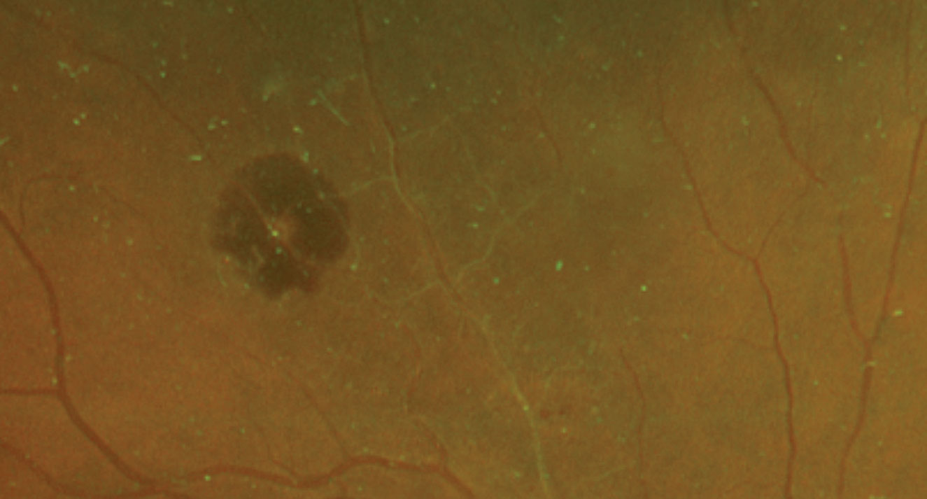 Fig. 1. These dilated fundus shots show changes to the 76-year-old patient’s retina. 