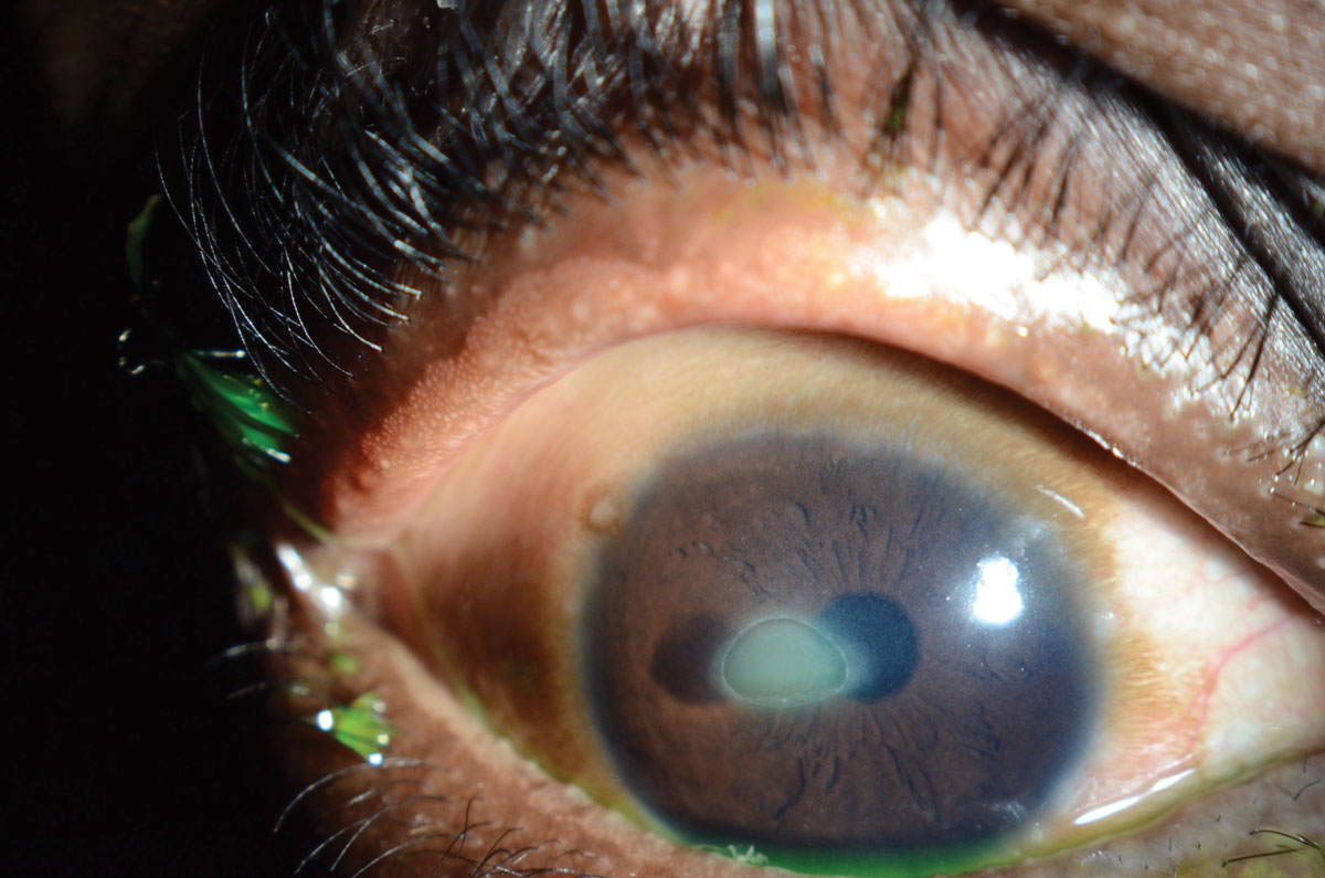 Fig. 4. Shield ulcers are possible in patients with vernal keratoconjunctivitis.