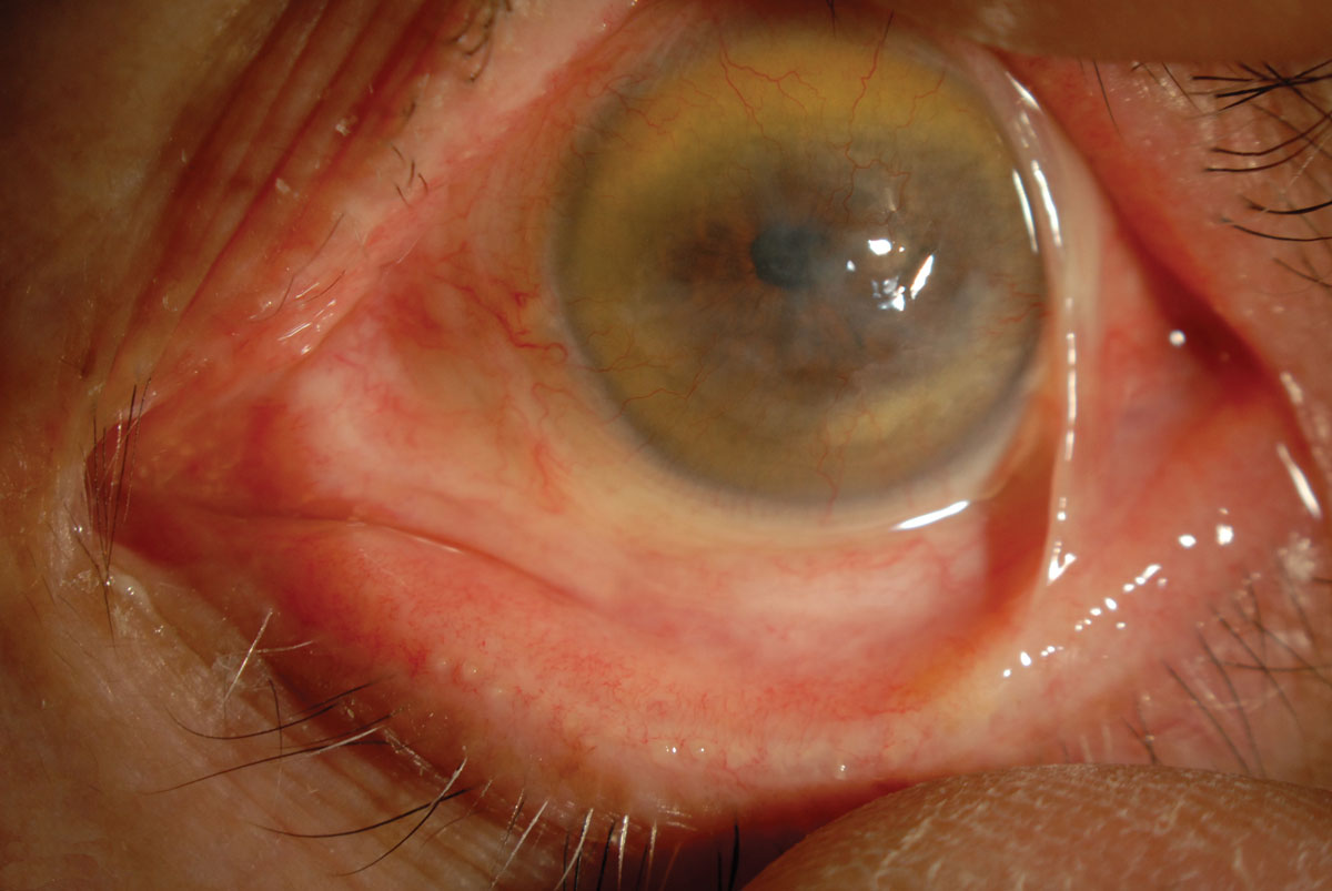 Fig. 5. Patients with severe ocular GVHD may present with symblepharon and corneal neovascularization.