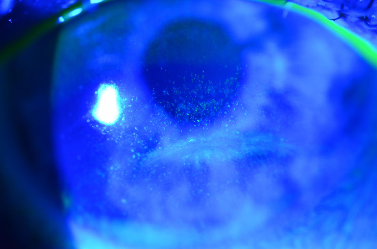 Fig. 6. This patient with lagophthalmos from facial nerve paralysis has interpalpebral corneal staining.