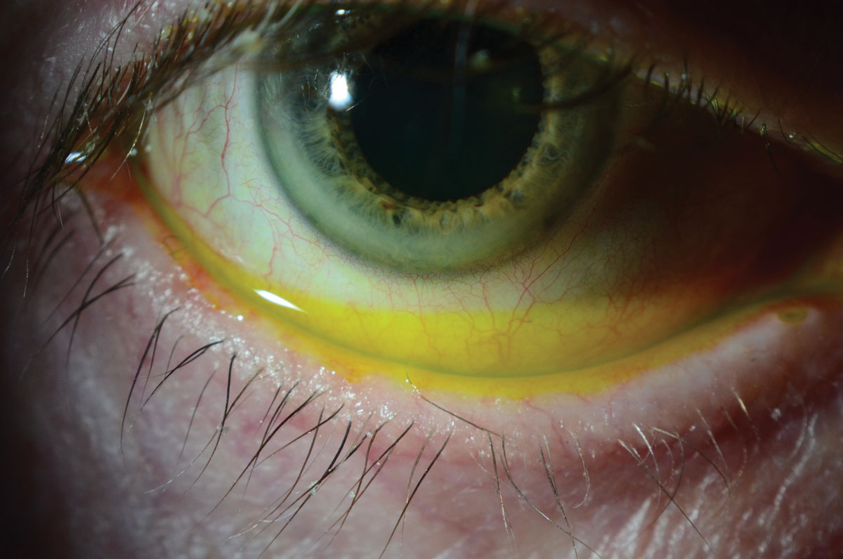 Fig. 7. This evaluation of the tear film with fluorescein reveals a high tear lake in a patient with paralytic lagophthalmos following surgery for squamous cell carcinoma of the parotid gland.