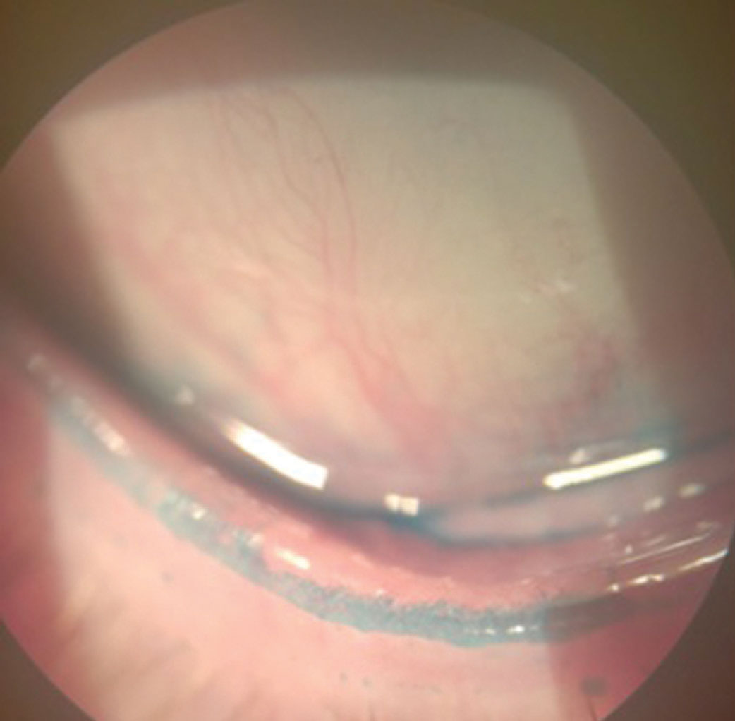 Lissamine green staining of the lid margin shows >2mm of stain, which would qualify as a positive sign of lid wiper epitheliopathy, a key diagnostic criteria for dry eye disease.