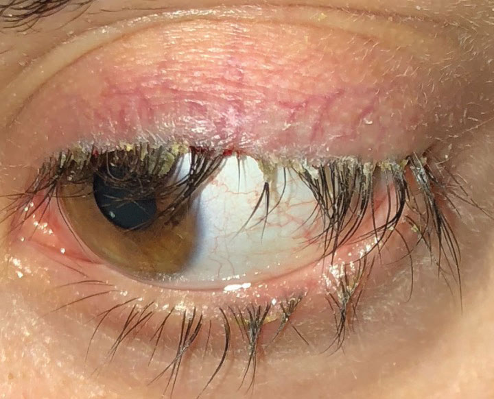 This patient with anterior blepharitis required stage two treatment, which can include topical antibiotics or antibiotic-steroid combination medications, along with lid hygiene and warm compresses. 
