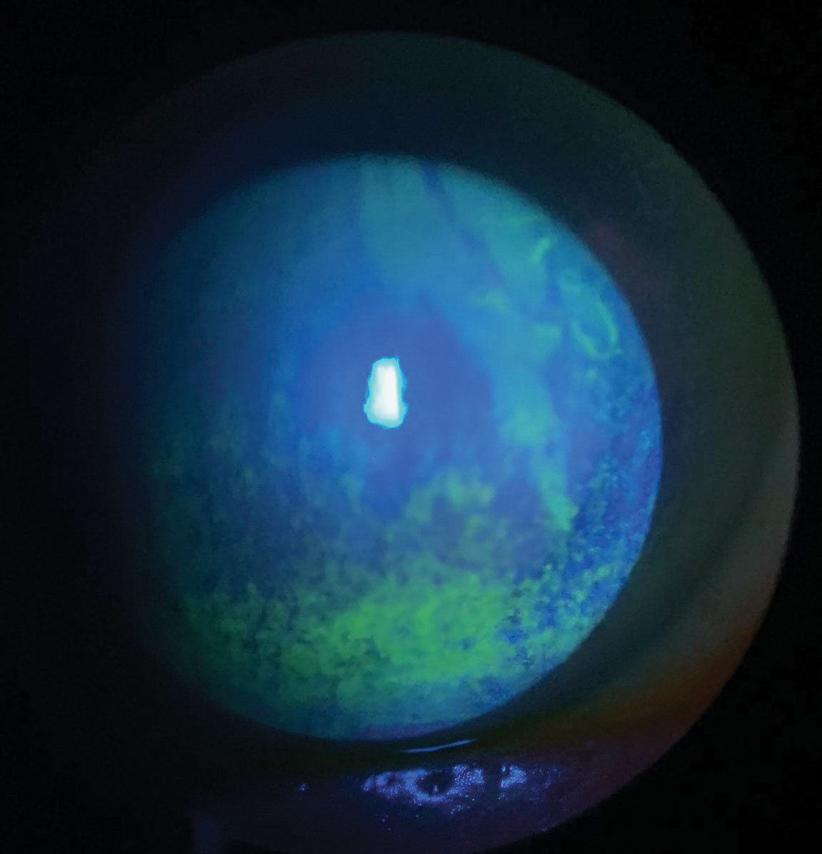 This patient with dry eye has extensive punctate epithelial keratitis and decreased tear break-up time. Treatment requires consideration of patient symptoms, underlying contributory systemic conditions and medication use. 