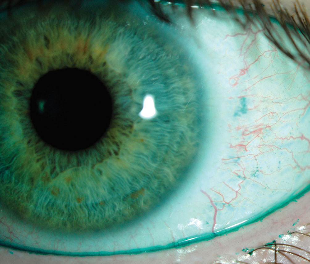 This positive lissamine green conjunctival staining indicates dry eye, whereas the lid margin staining is indicative of lid wiper epitheliopathy. Cyclosporine drugs offer these kinds of patients relief. Photo by Jalaiah Varikooty. 