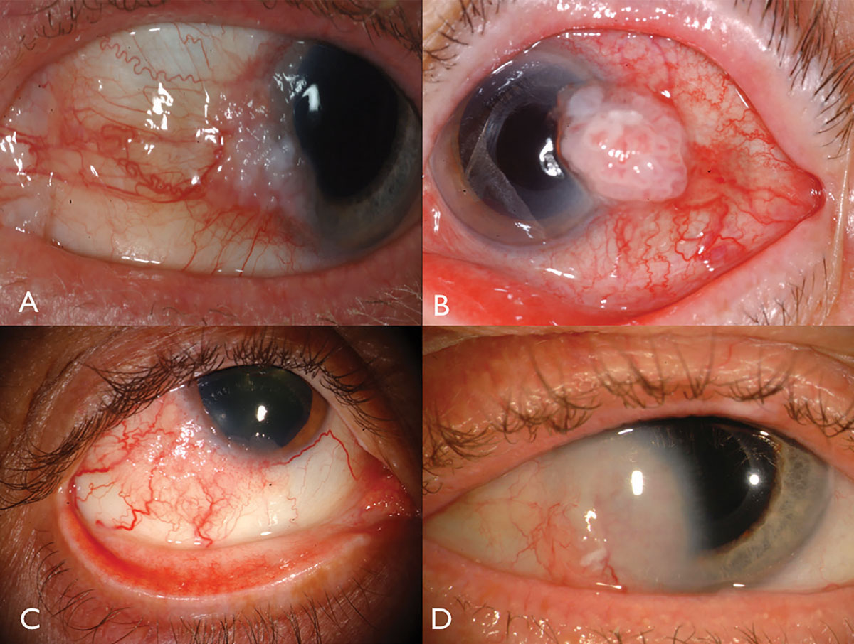 Fig. 1. Limbal OSSN: with leukoplakia and corneal involvement (A), with prominent intrinsic vascularity and feeder vessels (B), in a HIV patient (C), and with deep corneal invasion requiring resection and plaque radiotherapy (D).